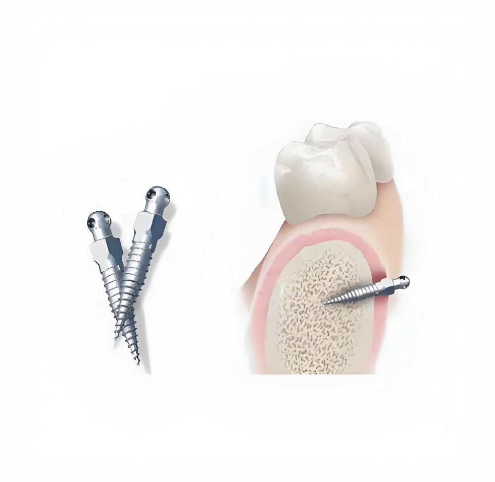 Dental Bone Screw Cleaning Solution